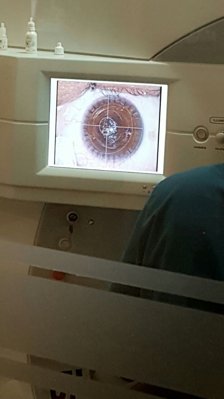 스마일 라식!!!!